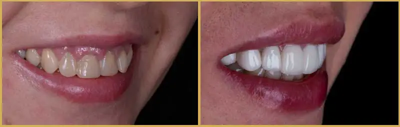 2 images side by side displaying a woman's smile before and after she was seen by the dentist at McHenry Smile Center.