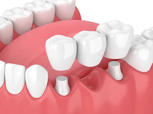 3D rendering of a dental bridge being placed over a missing tooth gap that is flanked by two shaved down teeth.