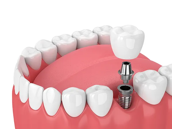 Dental implant diagram at McHenry Smile Center.