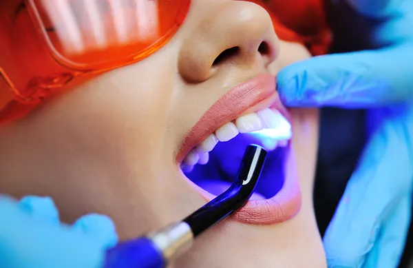 Close up of a dental assistant applying a UV light to a white female patient's newly sealed teeth.