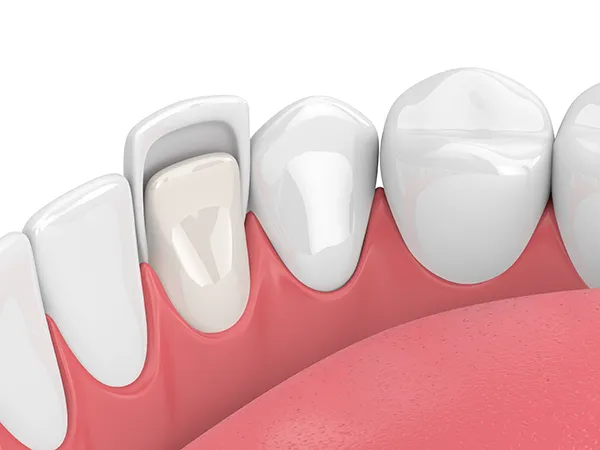 Close up 3D rendering of a thin porcelain veneer being applied to a tooth.