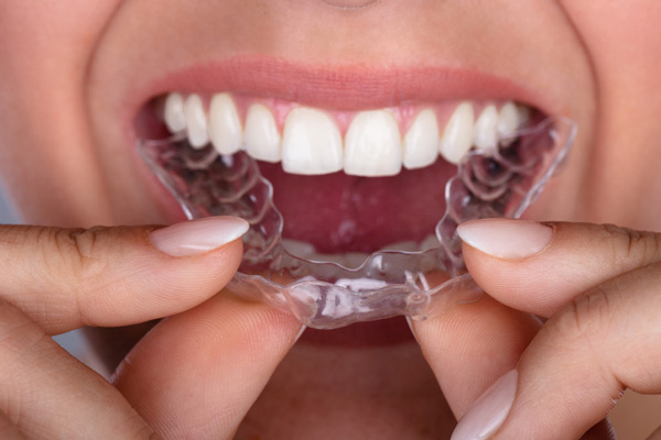 Close up of a woman putting clear aligner on her teeth.