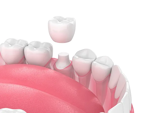 Close up 3D rendering of a shaved down tooth being capped with a porcelain crown.