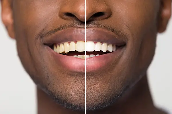 Close up comparison of before and after teeth whitening treatment on a young man's smile.