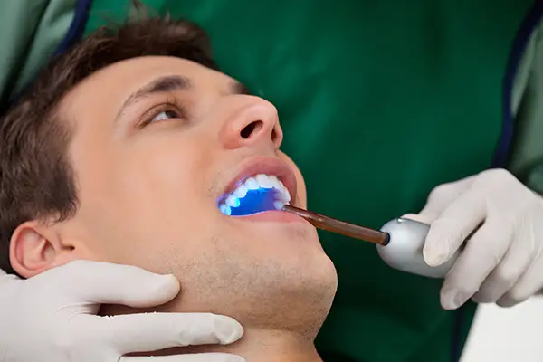 A dentist using a curing light to apply a dental sealant on a male patient's teeth during a dental procedure in a clinic.