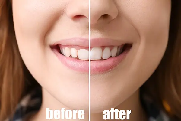 Before and after comparison of a woman's smile showing improved gum contour after crown lengthening.